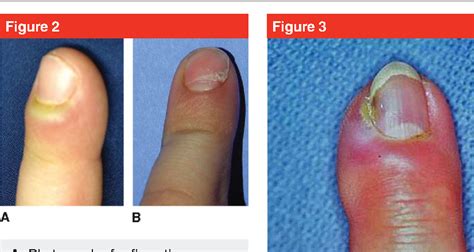 Paronychia of right toe icd 10  Right external ear cellulitis